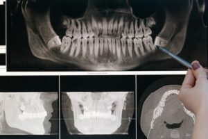 Radiographie dentaire détaillée montrant la structure des dents mise en évidence par un stylo pointeur.